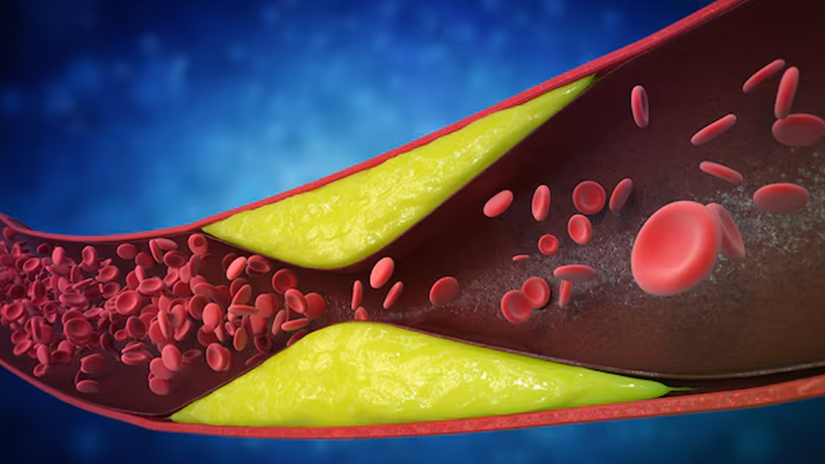 Atherosclerosis and Arteriosclerosis 3 - 2025-07-10T152335.808