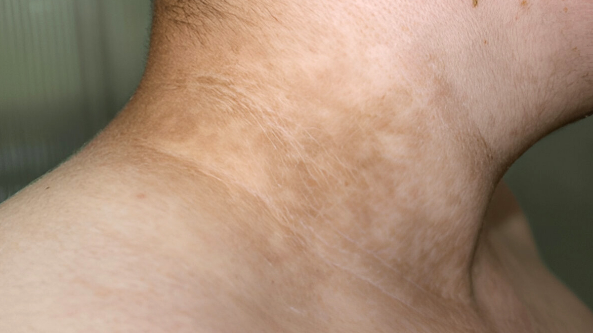 Acanthosis-Nigricans