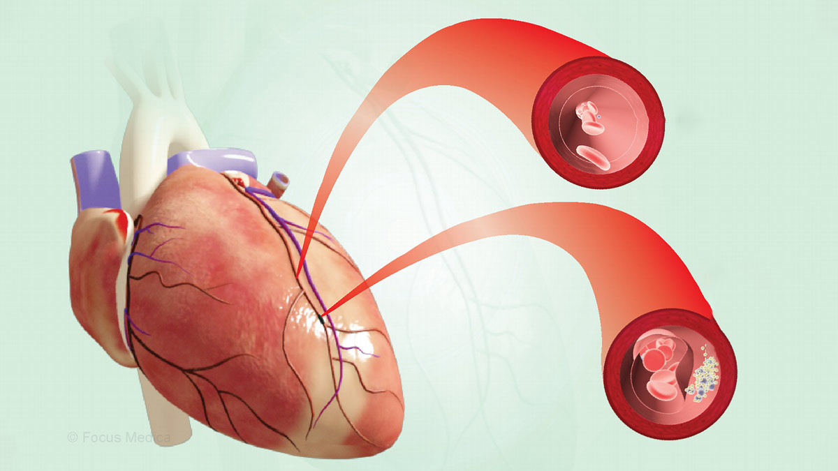Atherosclerosis and Arteriosclerosis causes mn - 2025-07-10T152337.305