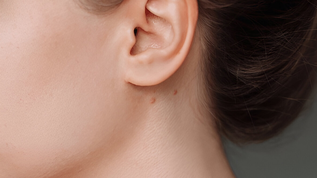 pimple-behind-ear
