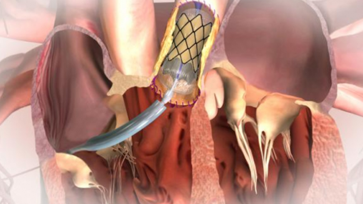 Heart Operations With Single Chest Cut 1 - 2025-07-11T134848.348