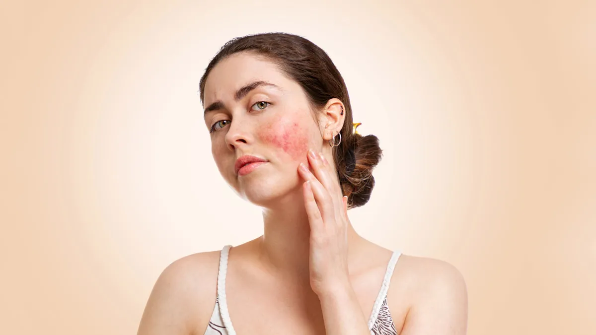 How To Naturally Soothe Your Face If You're Allergic To Aloe Vera Gel?