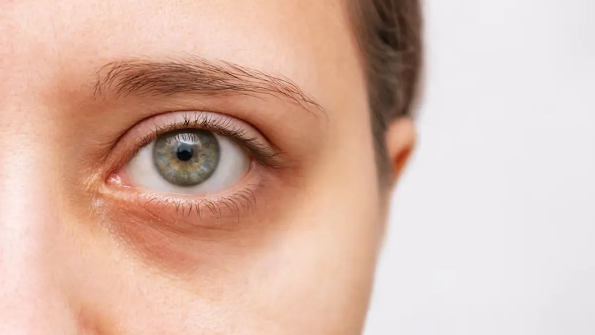 Do Late Nights Really Cause Dark Circles? Find Out Here