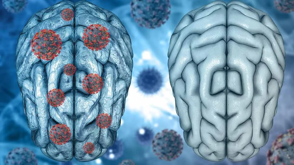 Anti-NMDA Receptor Encephalitis: The Rare Brain Condition That May Mimics The Flu And Psychiatric Illness; Here’s What To Know