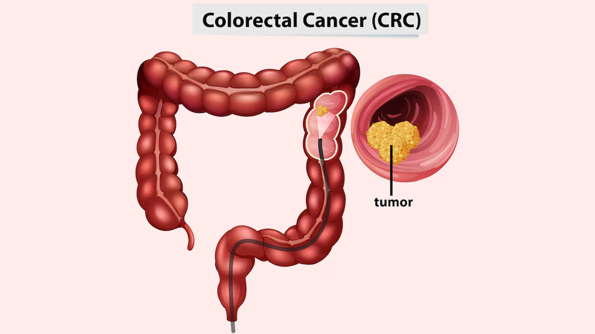 colorectal-cancer
