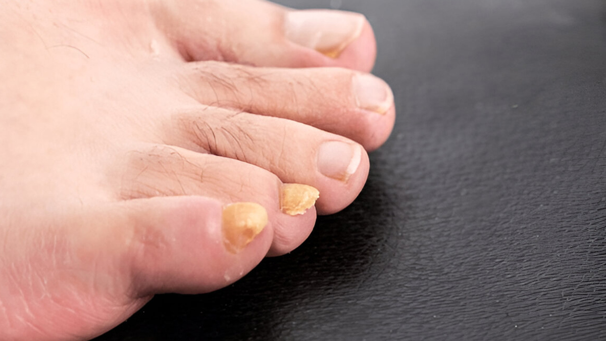 toe-nail-fungal-infection