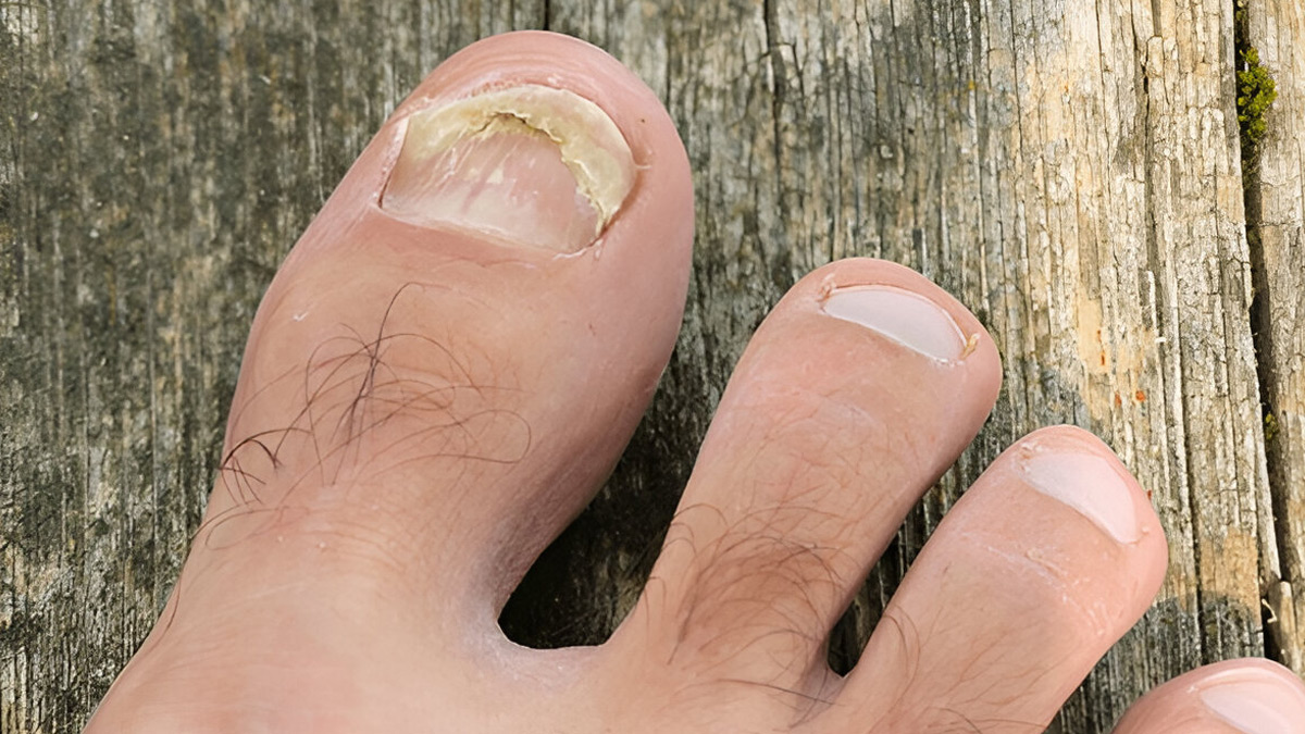 toe-nail-infection