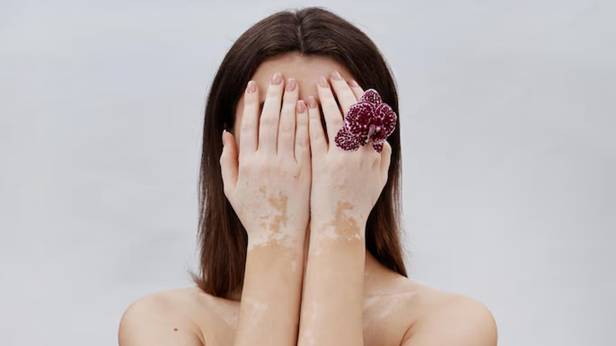 Mental Health Matters: How Vitiligo Affects Your Mental Health?