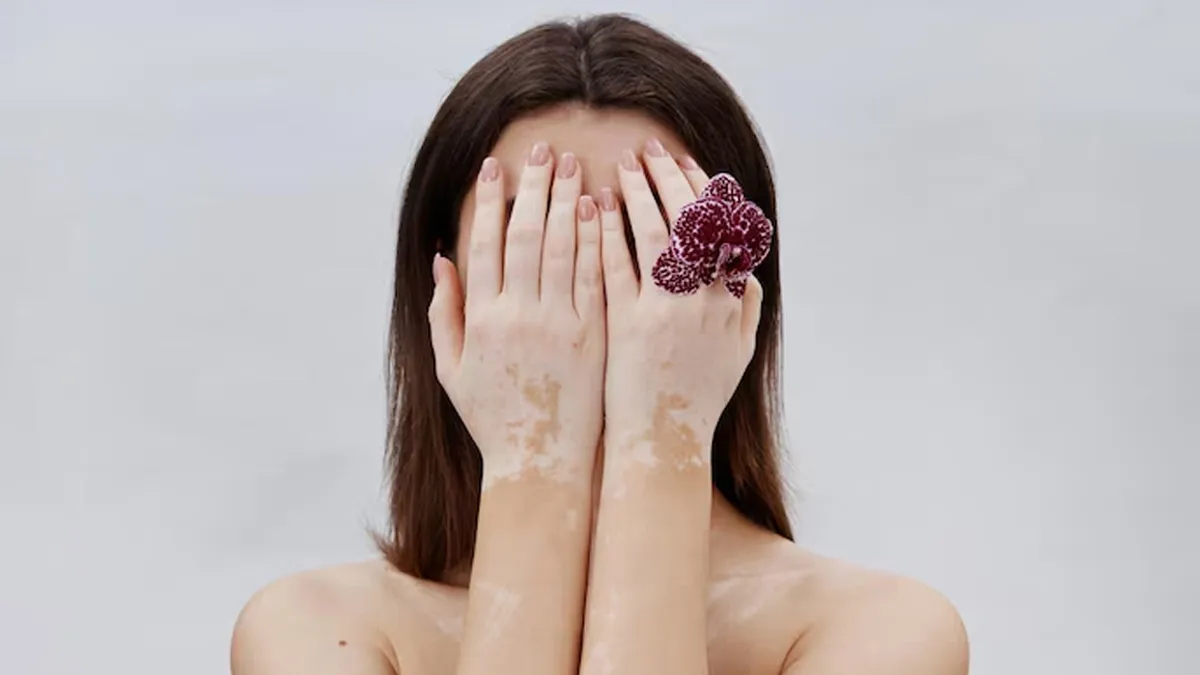 Mental Health Matters: How Vitiligo Affects Your Mental Health?