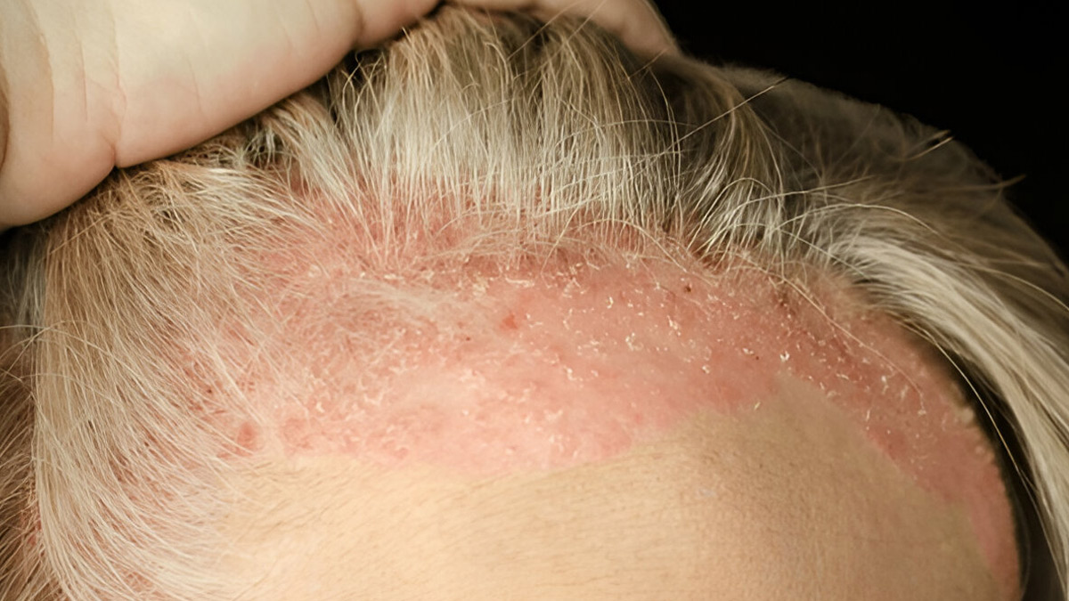scalp-psoriasis