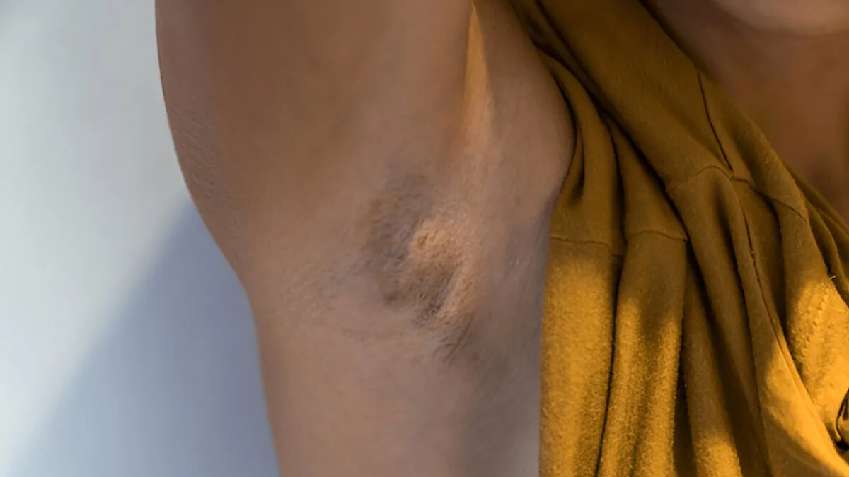 Hidradenitis Suppurativa: Not Just A Pimple; Chronic Inflammatory Skin Condition You Need To Know About