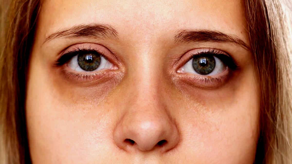 Woke Up With Swollen Eyes? Here’s How the Monsoon Affects Your Eyes and Ways To Prevent It