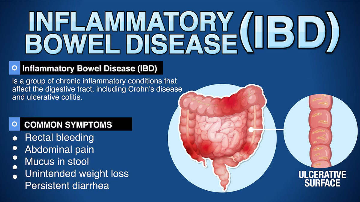 IBD Symptoms
