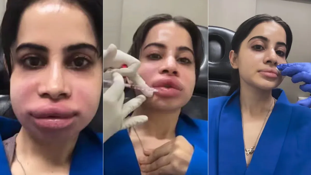 What Happens After Dissolving Lip Fillers? Urfi Javed’s Swollen Face Raises Questions About the Procedure