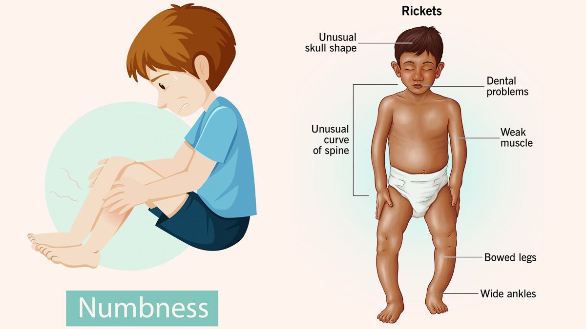 Rickets in Kids: Prevention and Treatment with Proper Diet