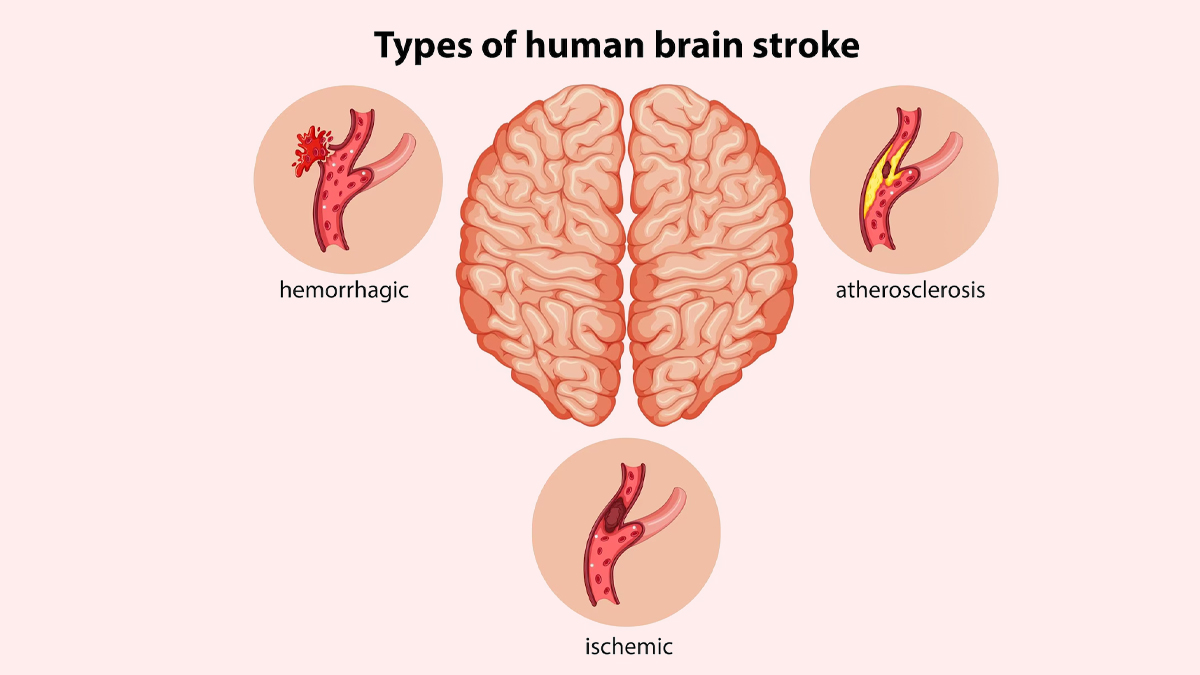 types of brain stroke