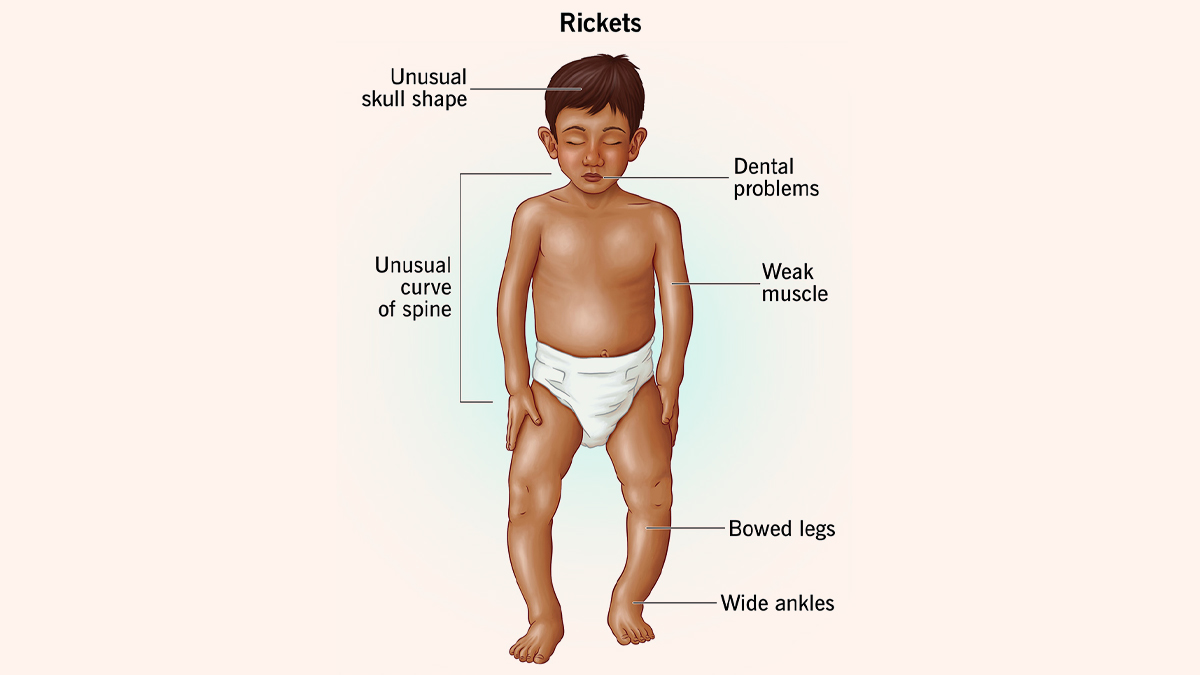 rickets in children
