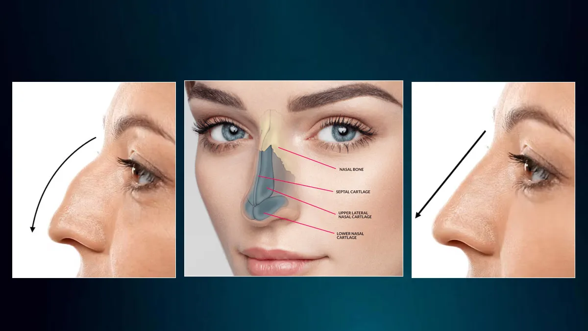 What Is Rhinoplasty: Things to Know Before Considering a Nose Job