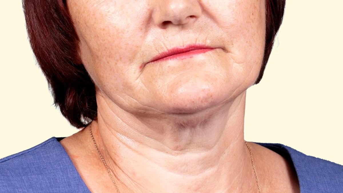Ways to Tackle Neck Wrinkles After 40, Dermat Tells