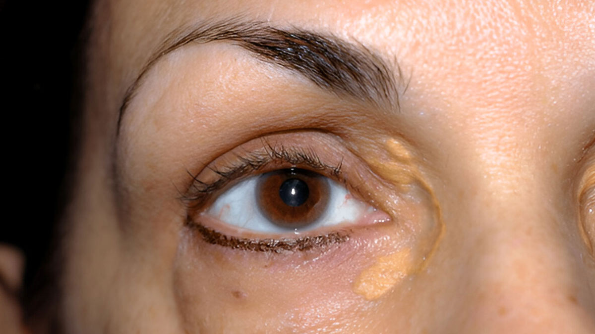 From Your Eyes To Your Ankles: Body Parts That Can Signal High Cholesterol