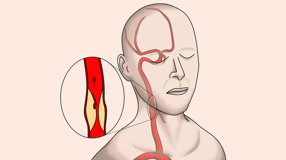 Carotid Artery Blockage test 1 - 2025-07-23T115614.615