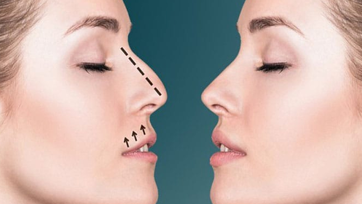 Rhinoplasty nose job 1 - 2025-07-23T123030.374