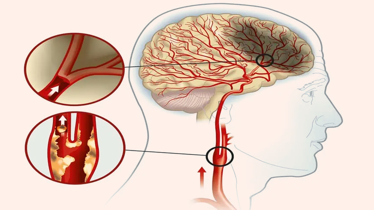 Carotid Artery Blockage rakesh roshan 2 - 2025-07-23T115616.697