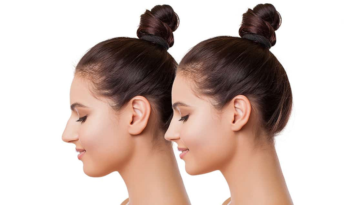 nosejob 3 - 2025-07-23T123023.364