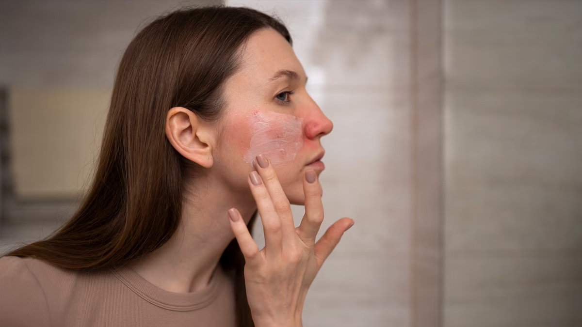 Monsoon Skin Problems: Homoeopathic Solutions That Work, Doctor Tells