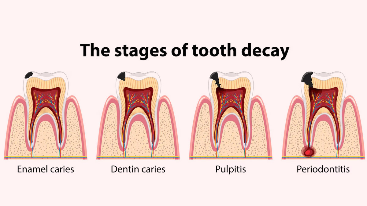Tooth decay
