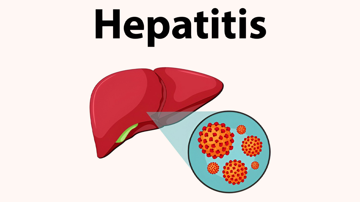 hepatitis