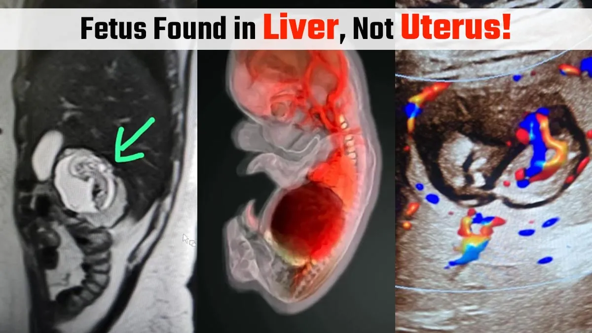 UP Woman’s 12-Week Fetus Found in Liver, Not Uterus: India’s First Intrahepatic Ectopic Pregnancy Suspected