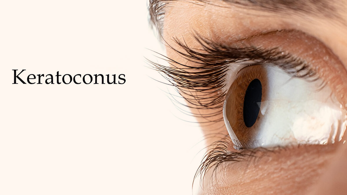 Blurry Nights And Constant Prescription Changes? It Could Be Keratoconus