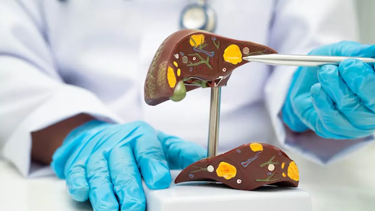 3 Out of 5 Liver Cancer Cases Are Preventable, Study Finds