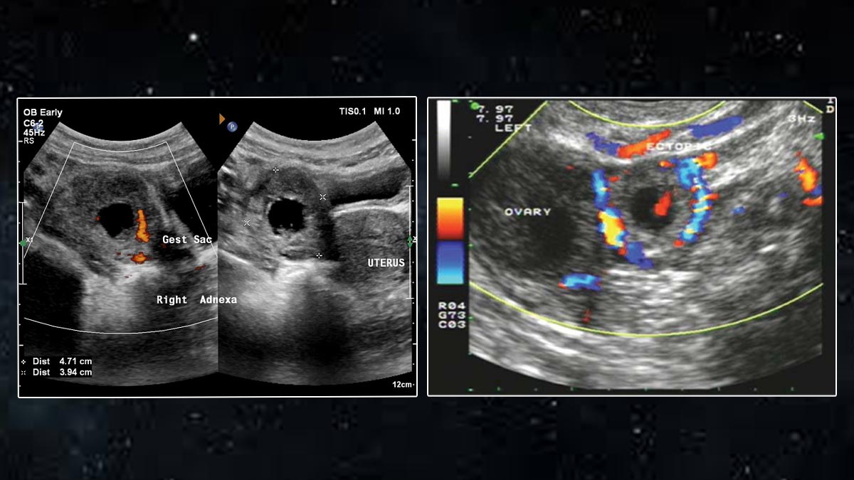 What Is Intrahepatic Ectopic Pregnancy? Doctor Explains India’s First Case of Liver Pregnancy