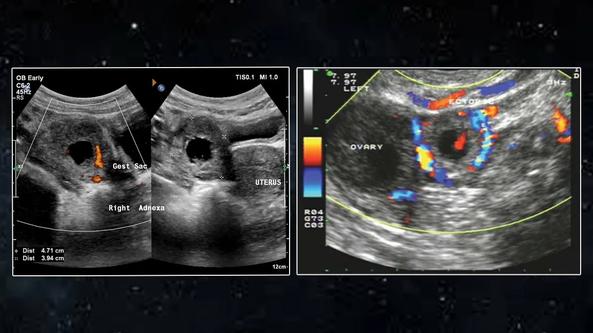 What Is Intrahepatic Ectopic Pregnancy? Doctor Explains India’s First Case of Liver Pregnancy