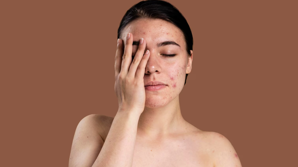Monsoon Skincare Guide: 7 Tips To Prevent Acne, Infections and Dullness