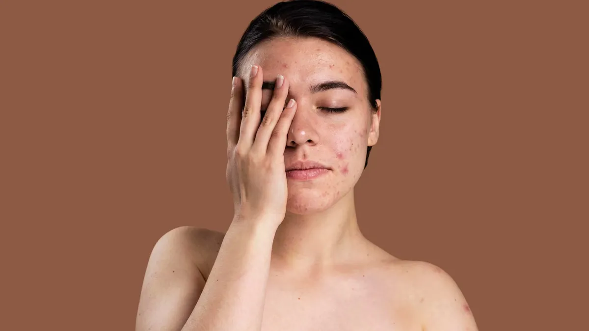 Monsoon Skincare Guide: 7 Tips To Prevent Acne, Infections and Dullness