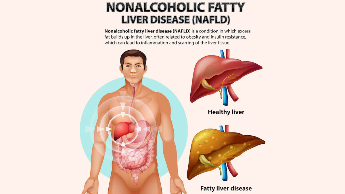 Non alcoholic fatty liver diseae