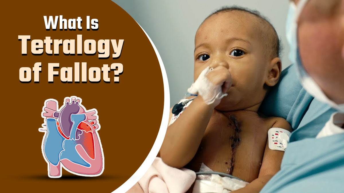 What is Tetralogy of Fallot: Exploring Complex Heart Condition’s Causes, Symptoms, and Treatment