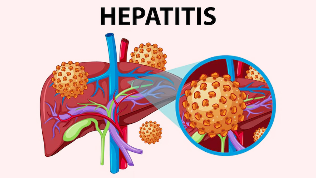 hepatitis