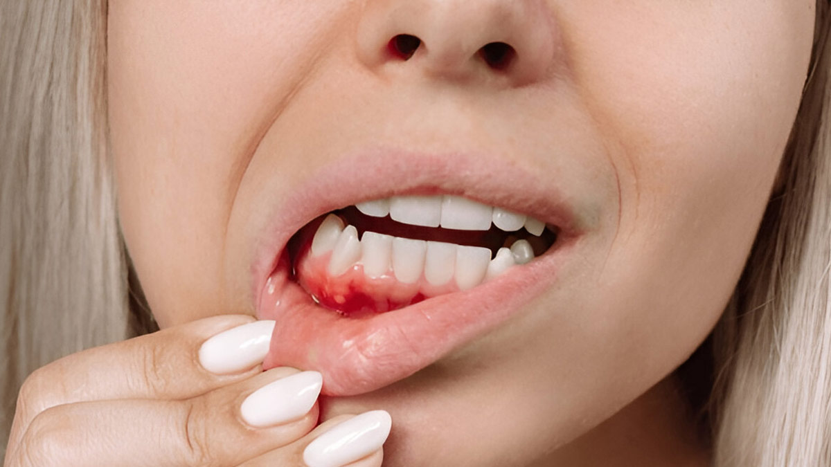 Bleeding Gums A Sign Of Menopause? We Asked An Expert