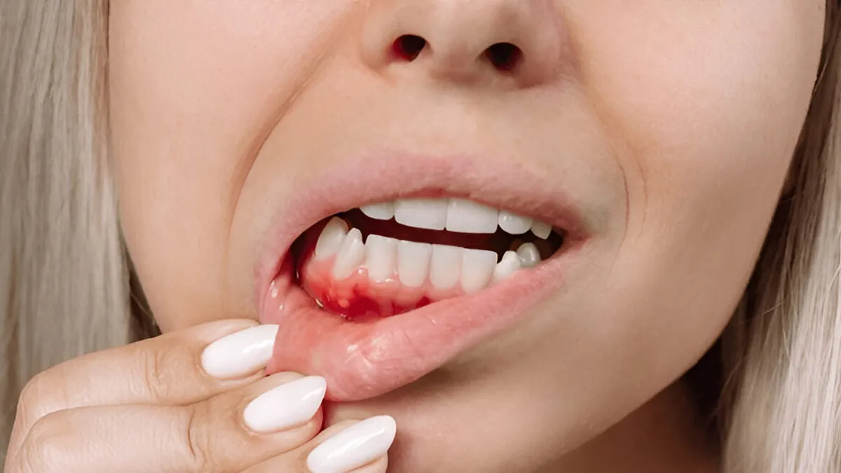 Bleeding Gums A Sign Of Menopause? We Asked An Expert