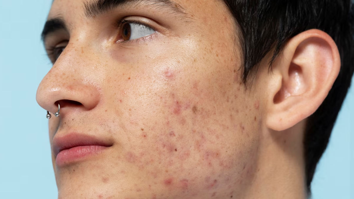 Fungal Vs. Bacterial Acne: How To Differentiate Between The Two