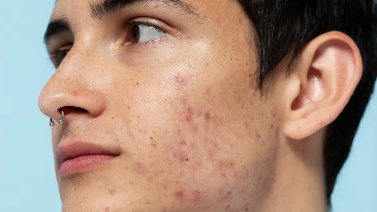 Fungal Vs. Bacterial Acne: How To Differentiate Between The Two