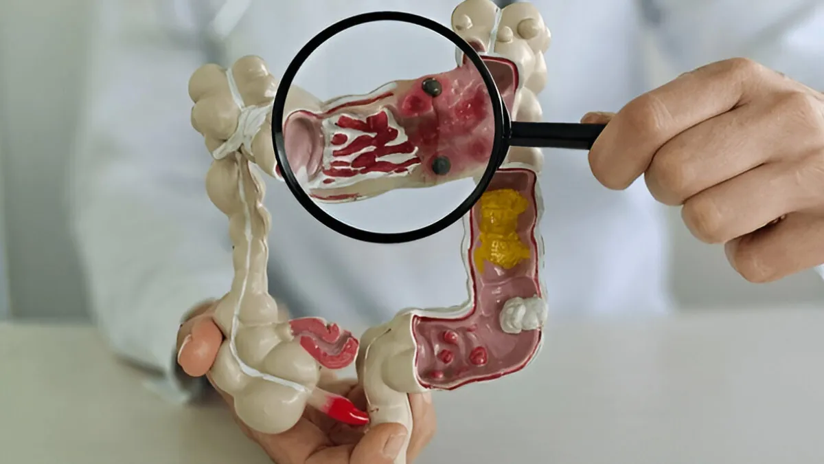 Colon Cancer Alert: 7 Foods To Ditch For A Healthier Gut
