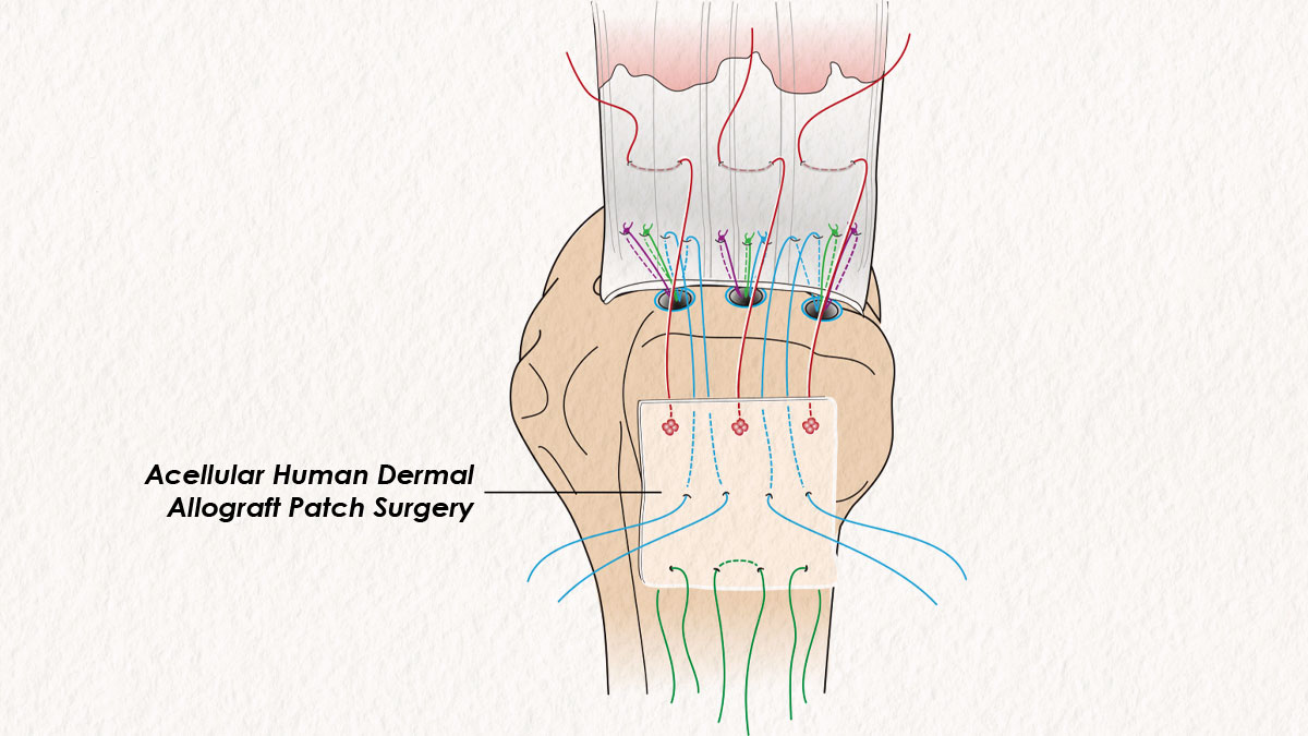 Acellular Human Dermal Allograft Patch Surgery Inisde-2