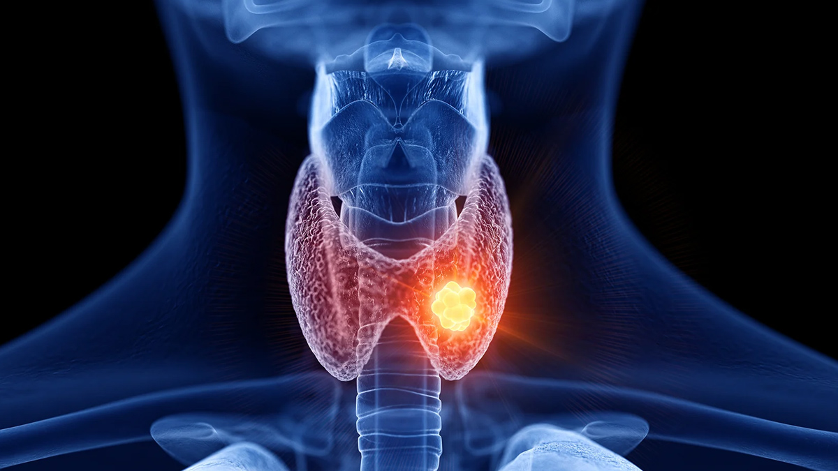 Hashimoto’s Disease 2 - 2025-08-08T112514.877