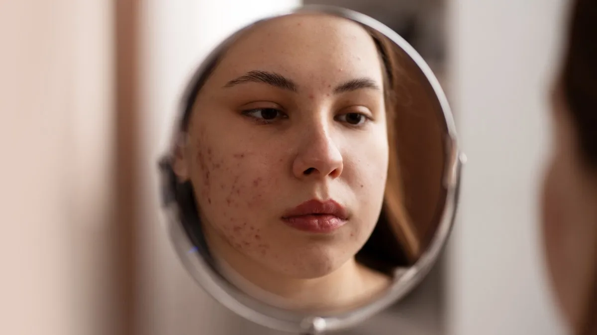 How To Distinguish Between PCOS Acne Vs. Normal Acne