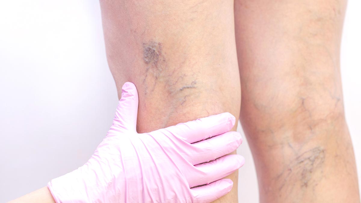 Best Exercises for Varicose Veins You Should Try Today